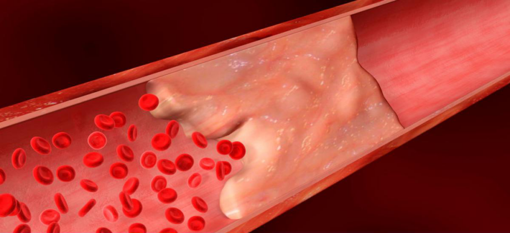 Calcificación Arterial